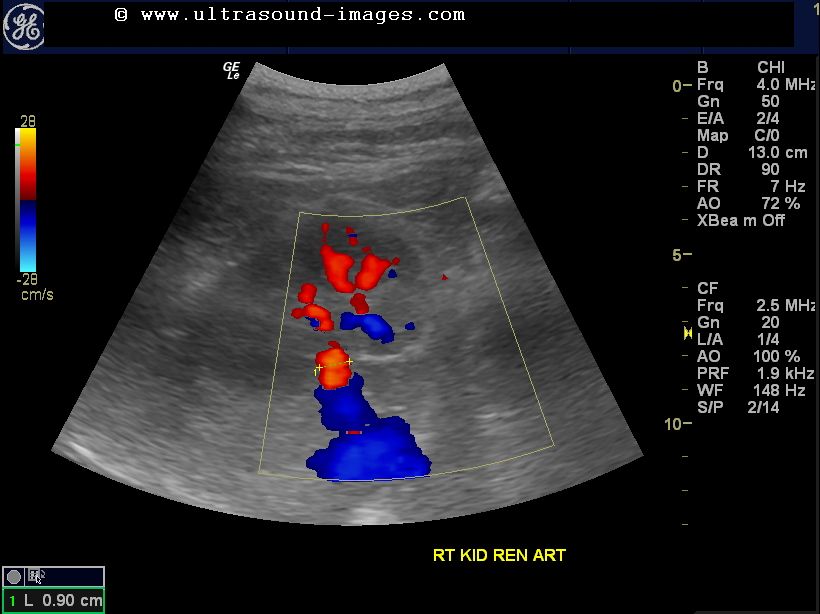 What is the renal artery Doppler test?
